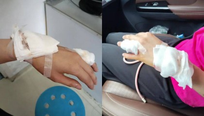 女子称大窑玻璃瓶静置时突然爆裂，致手指肌腱损伤接受缝合手术，企业回应