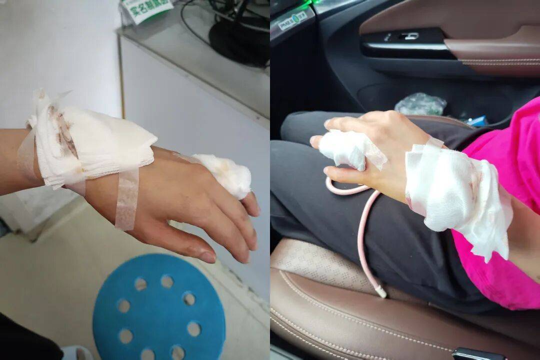 女子称大窑玻璃瓶静置时突然爆裂，致手指肌腱损伤接受缝合手术，企业回应